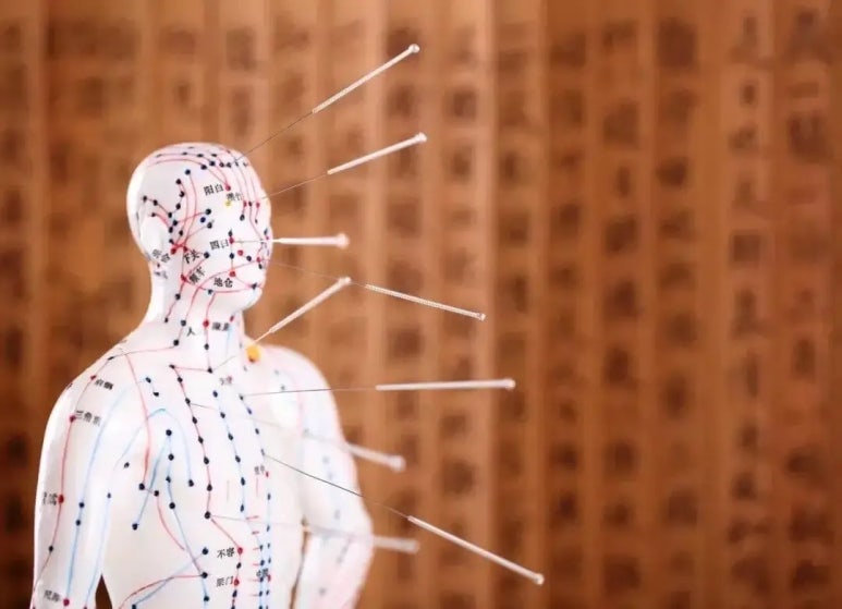 경혈 자극을 통한 침 치료 — 경추 디스크 치료의 기본