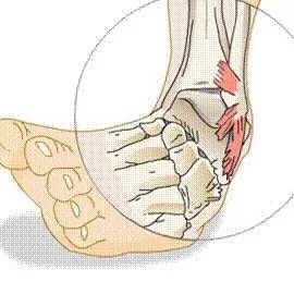 발목을 너무 자주 삐어서 힘들어요 — 만성 발목 염좌