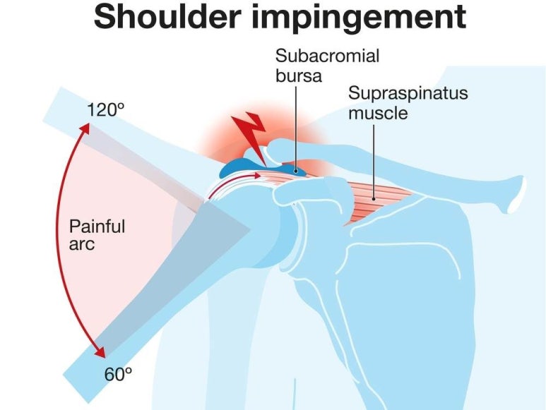 견봉하 공간이 좁아져 힘줄이 마찰되는 충돌증후군 — 60~120°의 painful arc