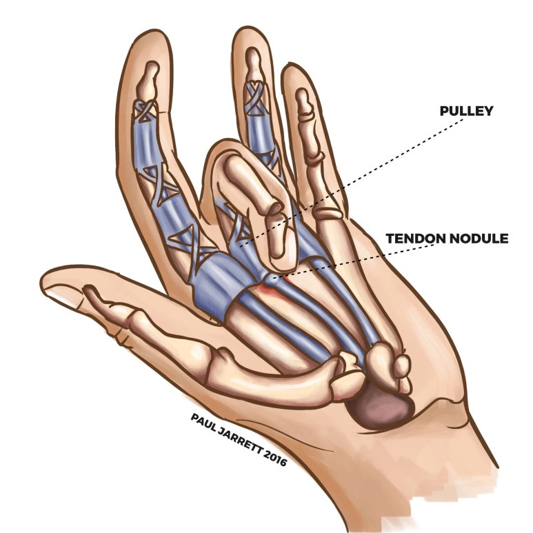굴곡건을 감싸는 활차(pulley)와 두꺼워진 힘줄 결절(tendon nodule)